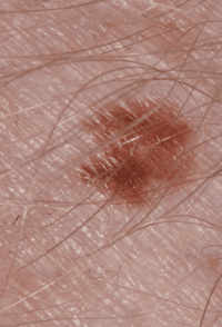 Melanoma that has developed from a suspicious dark mole.
