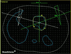 2D radiotherapy plan .