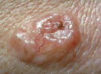 Photograph of basal cancer cell.