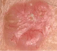 Photograph of basal cancer cell.