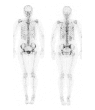 Diagram showing bone scan hot spots.