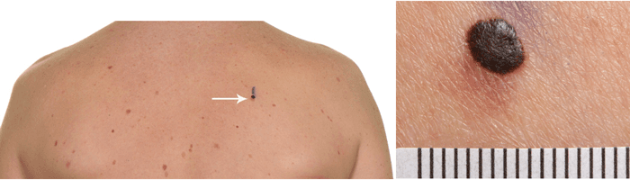 Melanoma presenting as a stand out lesion.