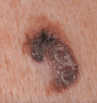 Melanoma from a new, odd-looking, growing lesion on the skin.