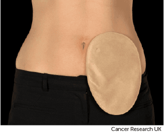 Photo showing one type of colostomy bag.