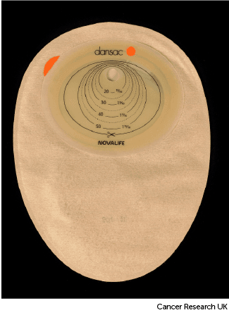 Photo showing the back of a colostomy bag .