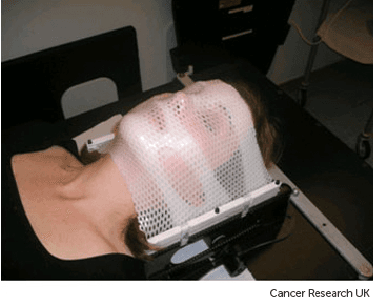 Photograph of a stereotactic radiotherapy mask for treating brain, head and neck cancers.