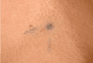 Photograph of radiotherapy tattoo marks.