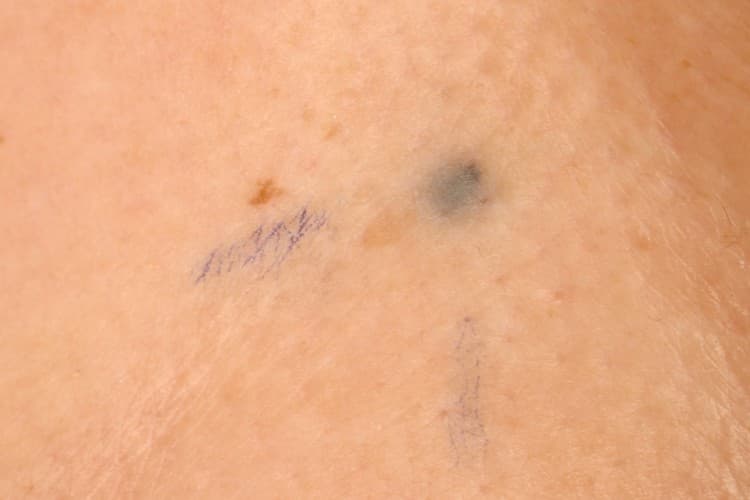 Photograph of radiotherapy tattoo marks.