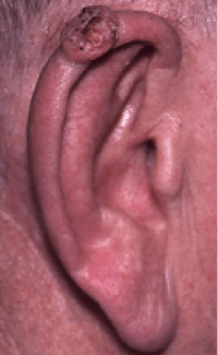 Photographs of squamous cell cancer on ear.